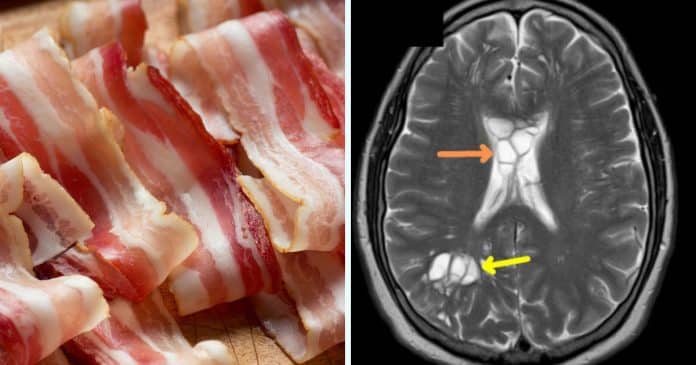 Homem que comia bacon “mal cozido” contrai uma infecção parasitária no cérebro; revelam médicos