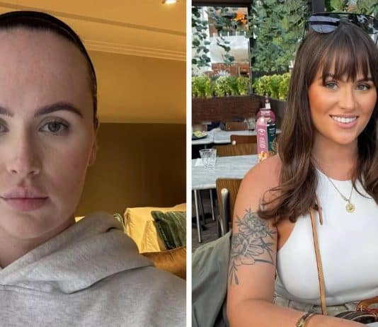 Mulher chamada de ‘cinco cabeças’ mostra resultado de cirurgia para redução da testa: “Tive franja a vida toda”