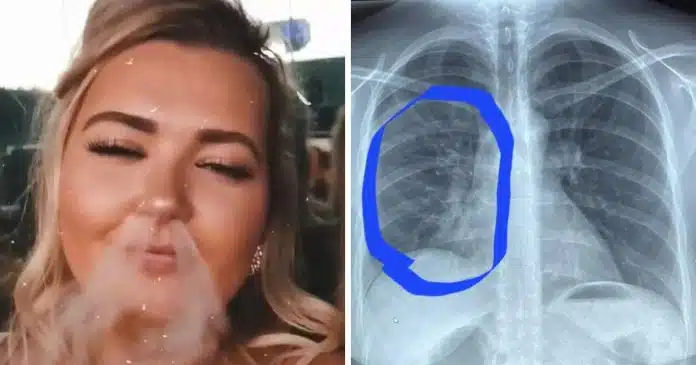 mulher-de-30-anos-fica-com-pulmoes-de-80-anos-depois-de-vaporizar-fritou-seus-pulmoes Mulher de 30 anos fica com pulmões como de alguém com 80 anos depois de vaporizar: “Fritou seus pulmões”