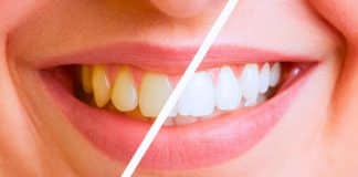 Especialista explica como evitar que os DENTES FIQUEM AMARELADOS