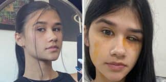Jovem viraliza ao ficar cega de um olho devido ao mau uso de lentes de contato