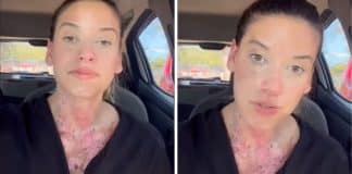 Empresária sofre queimaduras de 2º grau ao verificar água no radiador do carro: “Desmaiei de dor”