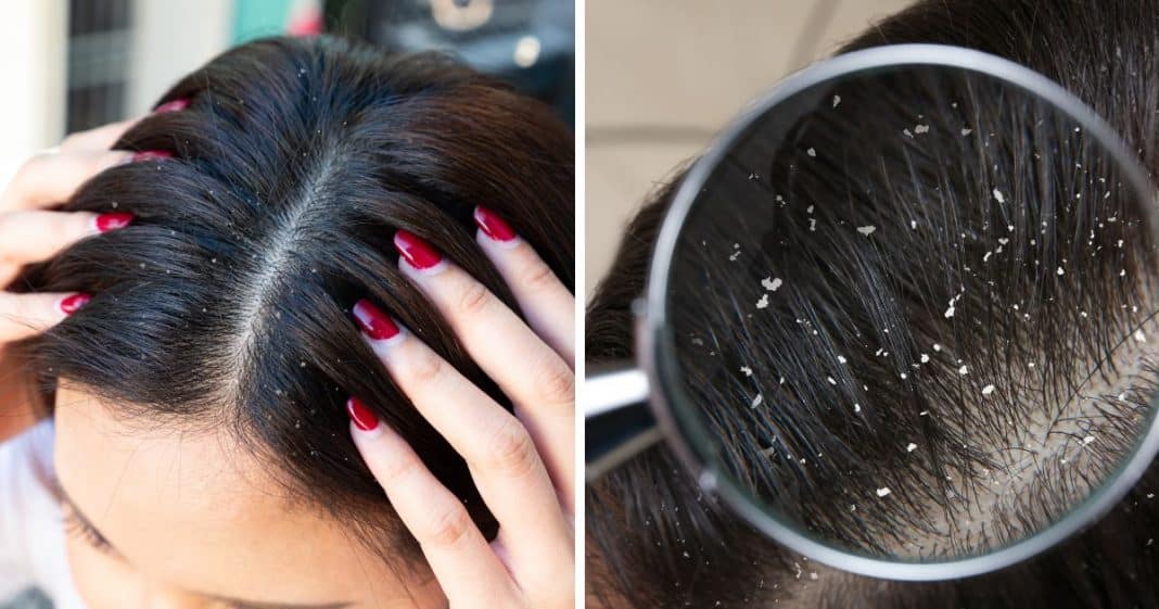 Você tem caspa? Descubra quais são as causas e os melhores tratamentos ...
