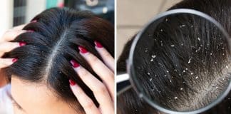 Você tem caspa? Descubra quais são as causas e os melhores tratamentos disponíveis