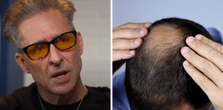 Biohacker revela solução simples para parar a queda de cabelo na juventude