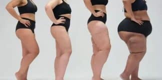 Lipedema: A “nova” doença reconhecida pela OMS que muitas mulheres têm e não sabem