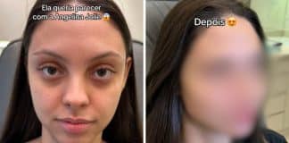VÍDEO: Jovem faz harmonização facial para ficar parecida com Angelina Jolie e resultado impressiona