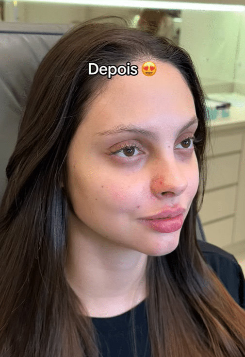 sabiaspalavras.com - V&Iacute;DEO: Jovem faz harmoniza&ccedil;&atilde;o facial para ficar parecida com Angelina Jolie e resultado impressiona