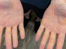 Homem choca médicos ao ‘vazar’ colesterol pelas mãos após aderir a dieta carnívora para emagrecer