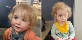 Criança de 2 anos perde a visão do olho esquerdo após ser beijado por uma pessoa com herpes labial