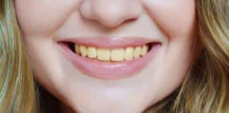 Estes são os principais motivos de por quê seus dentes estão amarelados – e como evitar?