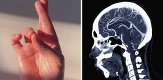 Teste de 7 segundos que afirma detectar Alzheimer ou AVC viraliza nas redes sociais