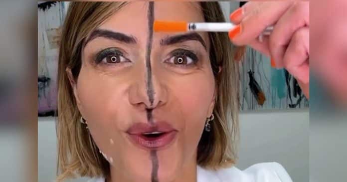 medica-aplica-botox-em-apenas-um-lado-rosto-e-resultado-assustador-viraliza Vídeo: Médica aplica Botox em apenas um lado rosto e resultado assustador viraliza