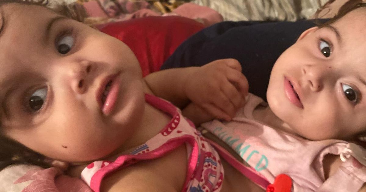 Depois de cirurgia de separação uma das irmãs gêmeas siamesas morre e outra permanece sedada em estado grave
