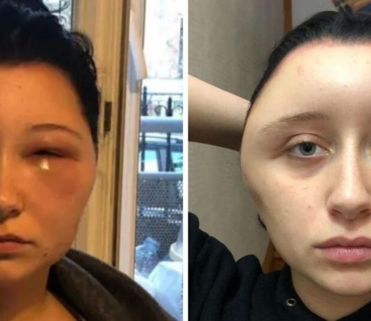 Jovem fica desfigurada depois de aplicar no cabelo tintura comum comprada em supermercado: “Quase morri”