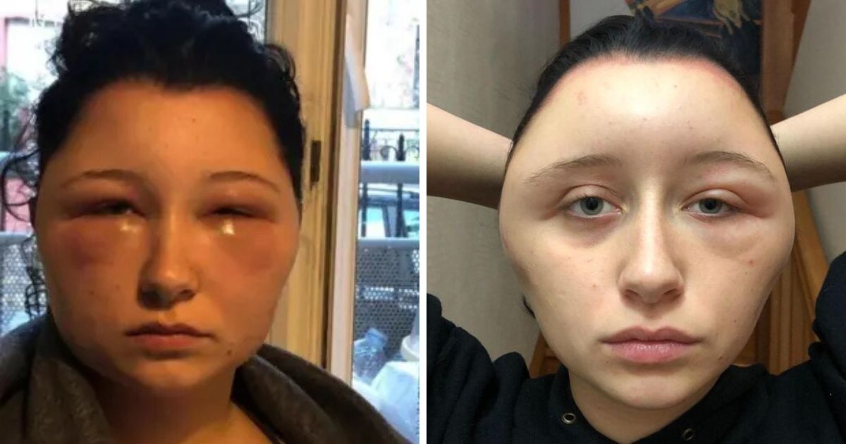 Jovem fica desfigurada depois de aplicar no cabelo tintura comum comprada em supermercado: “Quase morri”