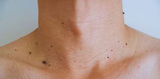 O que realmente causa ‘Acrocórdons’? Dicas naturais para reduzir estas protuberâncias de pele