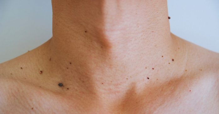 O que realmente causa ‘Acrocórdons’? Dicas naturais para reduzir estas protuberâncias de pele