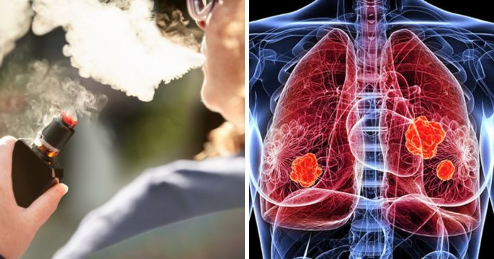 vape-e-oficialmente-associado-a-uma-doenca-pulmonar-grave-irreversivel-pulmao-de-pipoca VAPE é oficialmente associado a uma doença pulmonar grave irreversível: “Pulmão de Pipoca”