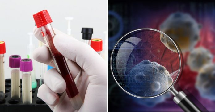 medicos-identificam-o-tipo-sanguineo-com-maior-risco-de-desenvolver-esse-tipo-de-cancer Médicos identificam o tipo sanguíneo com maior risco de desenvolver esse tipo de câncer