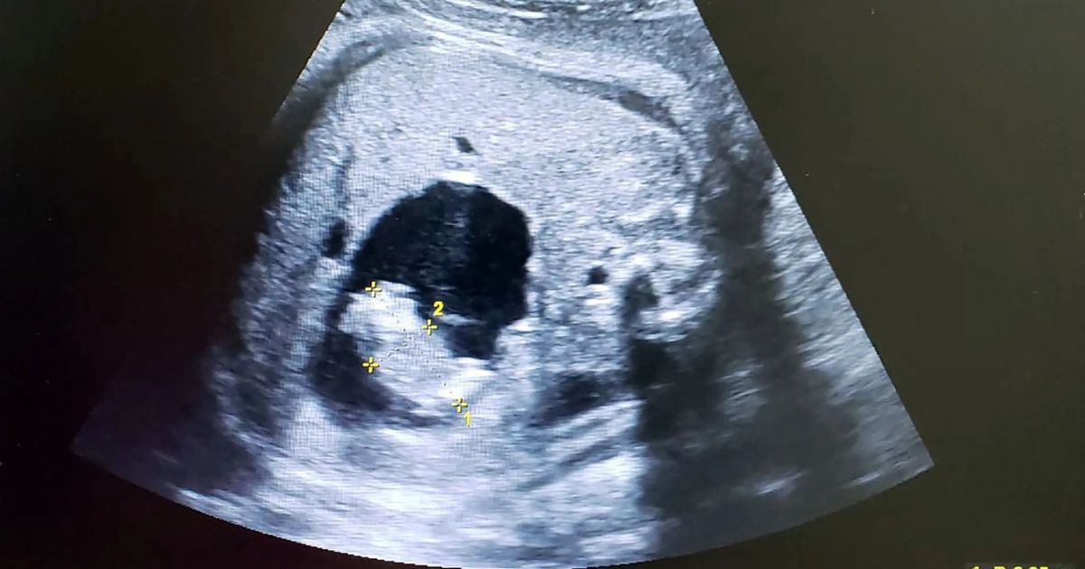 Mistério médico raríssimo choca ao bebê nascer com irmã gêmea dentro do abdômen na Colômbia