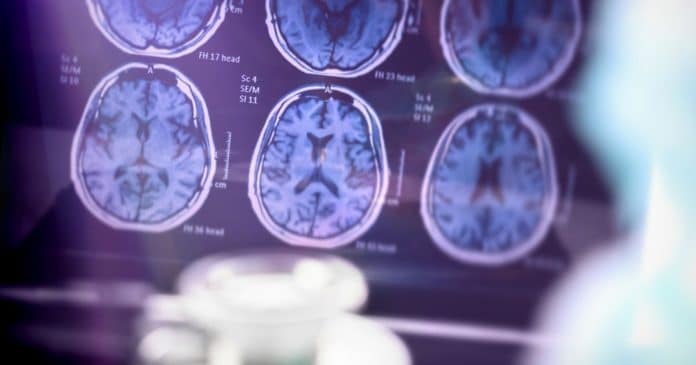 alzheimer-pode-ter-origem-infecciosa-o-que-a-ciencia-ja-descobriu-sobre-essa-hipotese Alzheimer pode ter origem infecciosa? O que a ciência já descobriu sobre essa hipótese
