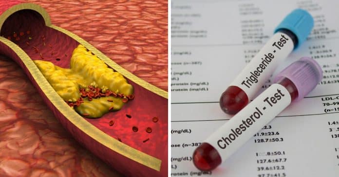 Cientistas descobrem um “interruptor” para o acúmulo de colesterol — e isso pode salvar milhões de vidas