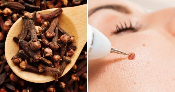 Como usar cravo-da-índia para tratar verrugas e pólipos de pele de forma natural