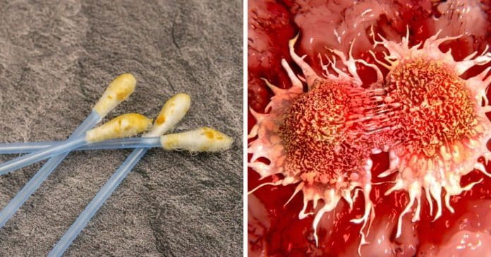 Estudo brasileiro revela que ‘sua cera de ouvido’ pode ajudar a detectar câncer antes do aparecimento do tumor
