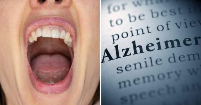 a-sua-boca-pode-estar-silenciosamente-causando-alzheimer-entenda-o-que-a-ciencia-esta-descobrindo A sua boca pode estar silenciosamente “causando” Alzheimer; Entenda o que a ciência está descobrindo