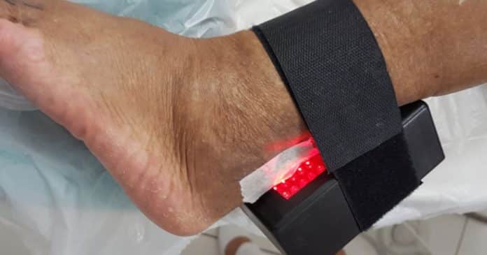 aparelho-criado-por-brasileira-acelera-cicatrizacao-de-pe-diabetico-e-evita-amputacoes-tecnologia-capaz-de-transformar-vidas Aparelho criado por brasileira acelera cicatrização de ‘pé diabético’ e evita amputações: “Tecnologia capaz de transformar vidas.”