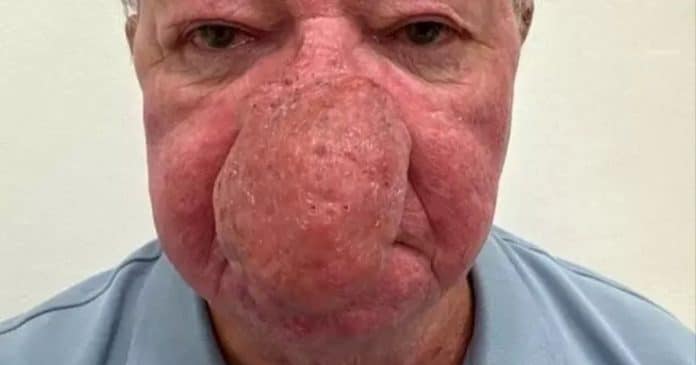 homem-com-pior-caso-de-crescimento-de-nariz-ja-visto-por-medicos-afirma-que-nao-conseguia-nem-beijar-a-esposa Homem com ‘pior caso’ de crescimento de nariz já visto por médicos afirma que não conseguia nem beijar a esposa
