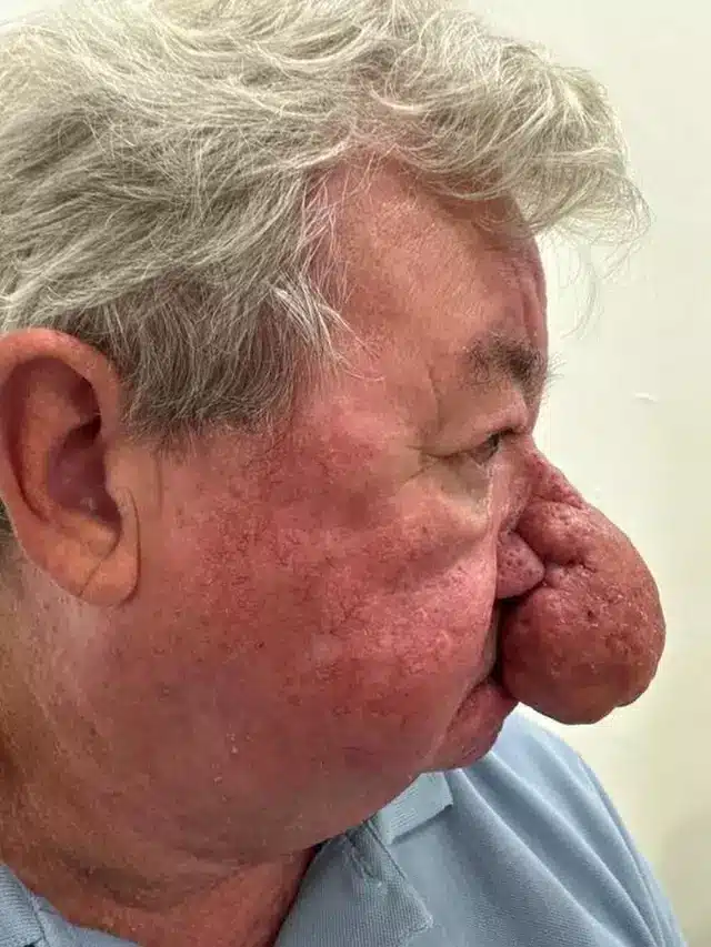 Homem com ‘pior caso’ de crescimento de nariz já visto por médicos afirma que não conseguia nem beijar a esposa sabiaspalavras.com - Homem com ‘pior caso’ de crescimento de nariz já visto por médicos afirma que não conseguia nem beijar a esposa