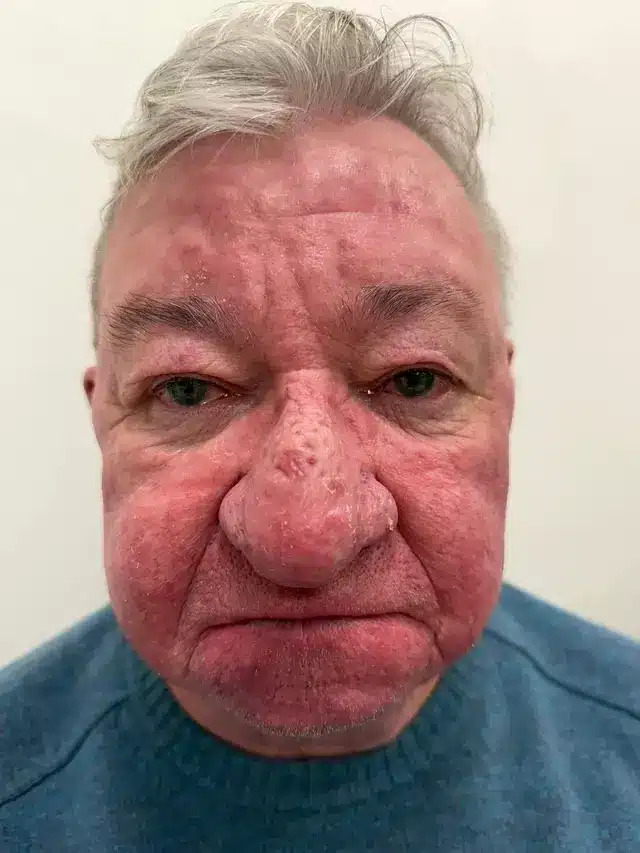 Homem com ‘pior caso’ de crescimento de nariz já visto por médicos afirma que não conseguia nem beijar a esposa sabiaspalavras.com - Homem com ‘pior caso’ de crescimento de nariz já visto por médicos afirma que não conseguia nem beijar a esposa