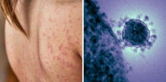 Casos de “doença grave” disparam em 2025 no Brasil e acendem alerta urgente de saúde pública