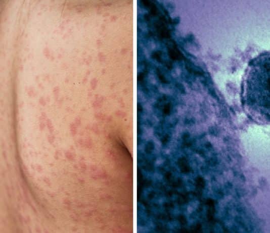 Casos de “doença grave” disparam em 2025 no Brasil e acendem alerta urgente de saúde pública