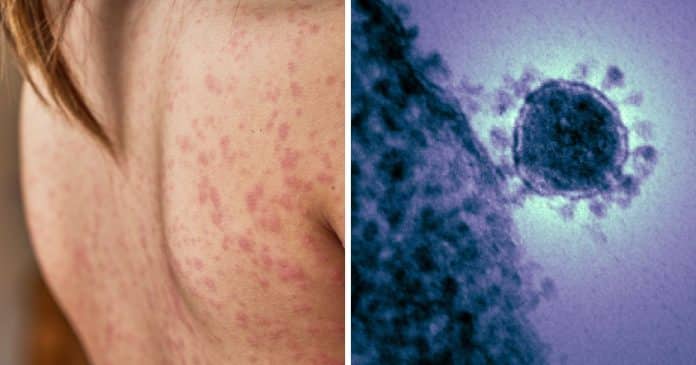 casos-de-doenca-grave-disparam-em-2025-no-brasil-e-acendem-alerta-urgente-de-saude-publica Casos de “doença grave” disparam em 2025 no Brasil e acendem alerta urgente de saúde pública