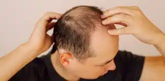 Cientistas descobrem possível “cura” para a calvície que promete resultados em apenas 20 dias