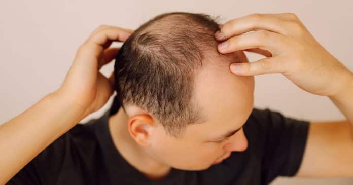 Cientistas descobrem possível “cura” para a calvície que promete resultados em apenas 20 dias