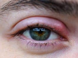 A causa para seu TERÇOL pode ser algo muito mais profundo que “seus olhos querem te dizer”