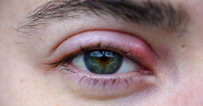 A causa para seu TERÇOL pode ser algo muito mais profundo que “seus olhos querem te dizer”