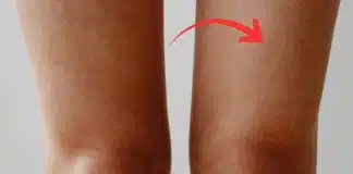 “Perna de morango”: por que surgem esses inconvenientes pontinhos pretos após a depilação e como tratar “Perna de morango”: por que surgem esses inconvenientes pontinhos pretos após a depilação e como tratar