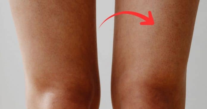 “Perna de morango”: por que surgem esses inconvenientes pontinhos pretos após a depilação e como tratar