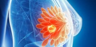 10 Sintomas silenciosos do câncer de mama que NUNCA devem ser ignorados