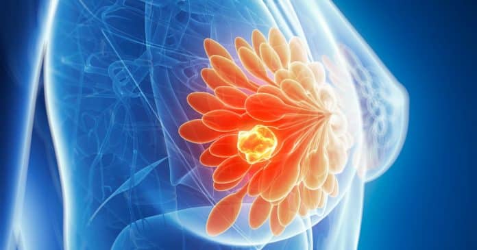 10 Sintomas silenciosos do câncer de mama que NUNCA devem ser ignorados