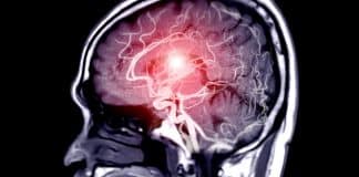 Especialistas em AVC alertam: 3 hábitos que você deve evitar após as refeições e 4 antes de dormir