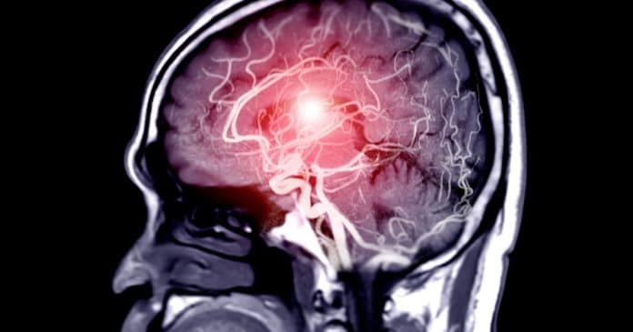 Especialistas em AVC alertam: 3 hábitos que você deve evitar após as refeições e 4 antes de dormir