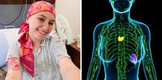 Linfoma de Hodgkin: sintomas que passam despercebidos e causas do câncer agressivo que tirou a vida de Isabel Veloso