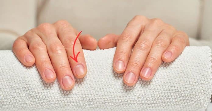 OLHE PARA A SUA UNHA AGORA: Se a ‘meia-lua’ sumiu, seu corpo pode estar pedindo socorro