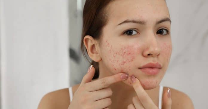 Ter acne no queixo e no maxilar não é acaso: o que seu corpo está tentando te alertar